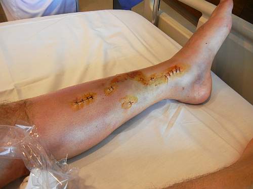 Incisions on Selwyn's leg